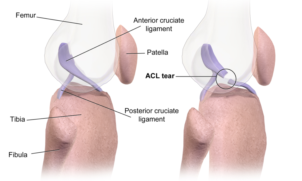 How to Prevent ACL Injury How to Prevent ACL Injury
